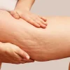 Lipödem und Bewegung: Wie regelmäßiges Training helfen kann