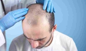 hair-transplant-in-pakistan